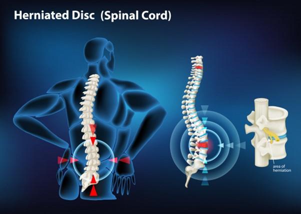 Physio for Low Back Pain & SI Joint Pain